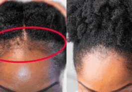 Grow your hairline in just 2 weeks with these steps
