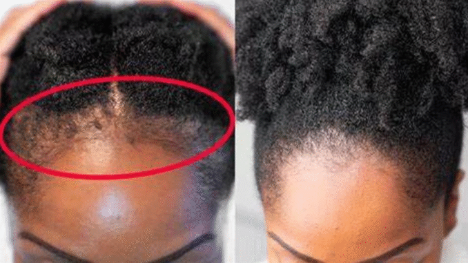 Grow your hairline in just 2 weeks with these steps Grow your hairline in just 2 weeks with these steps