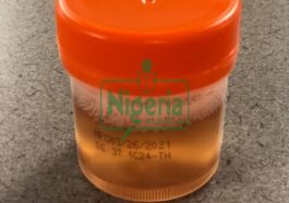 DANGER: If Your Urine Always Foams, Here Are 5 Possible Causes