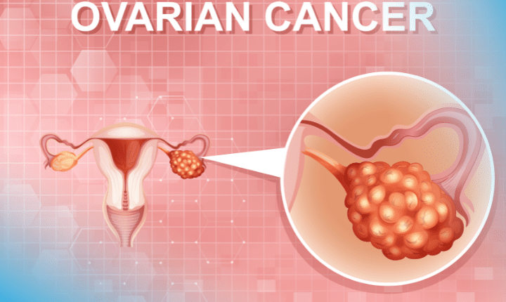 Symptoms Warning Signs of Ovarian Cancer That Many Women Overlook Symptoms Warning Signs of Ovarian Cancer That Many Women Overlook