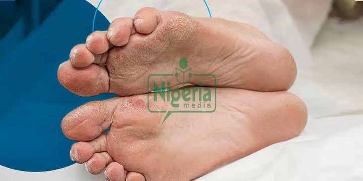 BREAKING NEWS: Four Symptoms Of Type 2 Diabetes Which Appear In Your Feet – What To Watch For BREAKING NEWS: Four Symptoms Of Type 2 Diabetes Which Appear In Your Feet – What To Watch For