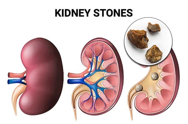Cleanse Your Kidneys Naturally in Just 5 Minutes: A Simple Home Remedy That Works