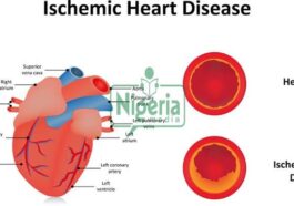 BREAKING NEWS: Understanding Ischemic Heart Disease