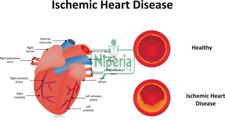 BREAKING NEWS: Understanding Ischemic Heart Disease