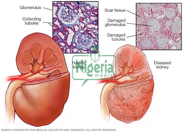 BREAKING: Repair Kidney Damage Quickly With Just One Teaspoon of Common Household Ingredients