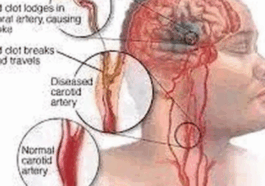 If You Don’t Want To Suffer Stroke At Old Age, Avoid Excess Intake Of These three Things