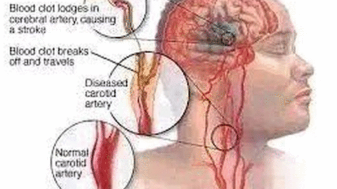 If You Don’t Want To Suffer Stroke At Old Age, Avoid Excess Intake Of These three Things If You Don’t Want To Suffer Stroke At Old Age, Avoid Excess Intake Of These three Things