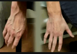 5 Reasons Why Some People Veins Appear Visible on Their Skin