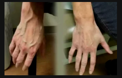 5 Reasons Why Some People Veins Appear Visible on Their Skin 5 Reasons Why Some People Veins Appear Visible on Their Skin