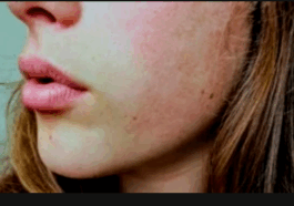 How To Remove Spots from Face In 2 Days Naturally