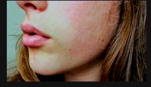 How To Remove Spots from Face In 2 Days Naturally How To Remove Spots from Face In 2 Days Naturally