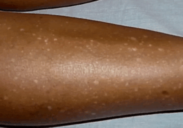 BREAKING: White Spots on Legs: What Causes Them and How to Get Rid of Them
