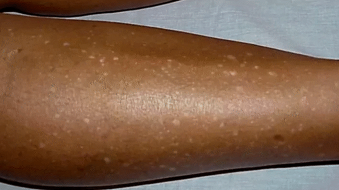 BREAKING: White Spots on Legs: What Causes Them and How to Get Rid of Them