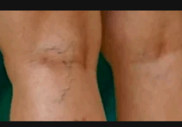 What Does It Mean When His Veins Look Like This?