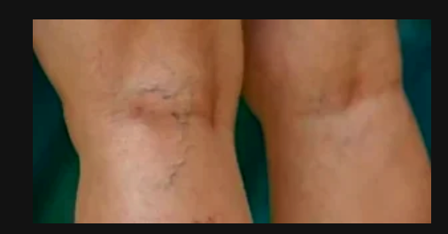 What Does It Mean When His Veins Look Like This?