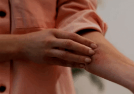 Sexually transmitted ringworm found in man who had affair with multiple men