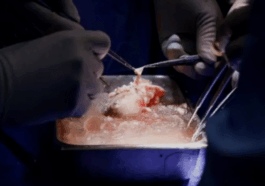 How doctors transferred pig’s kidney into human patient for the first time
