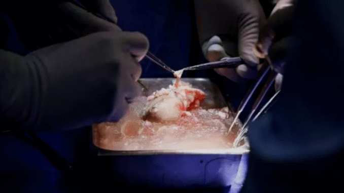 How doctors transferred pig’s kidney into human patient for the first time